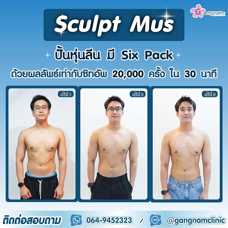 สร้างซิกแพค ด้วย Sculpt-Mus คืออะไร? กี่ครั้งเห็นผล? ได้ผลจริงไหม