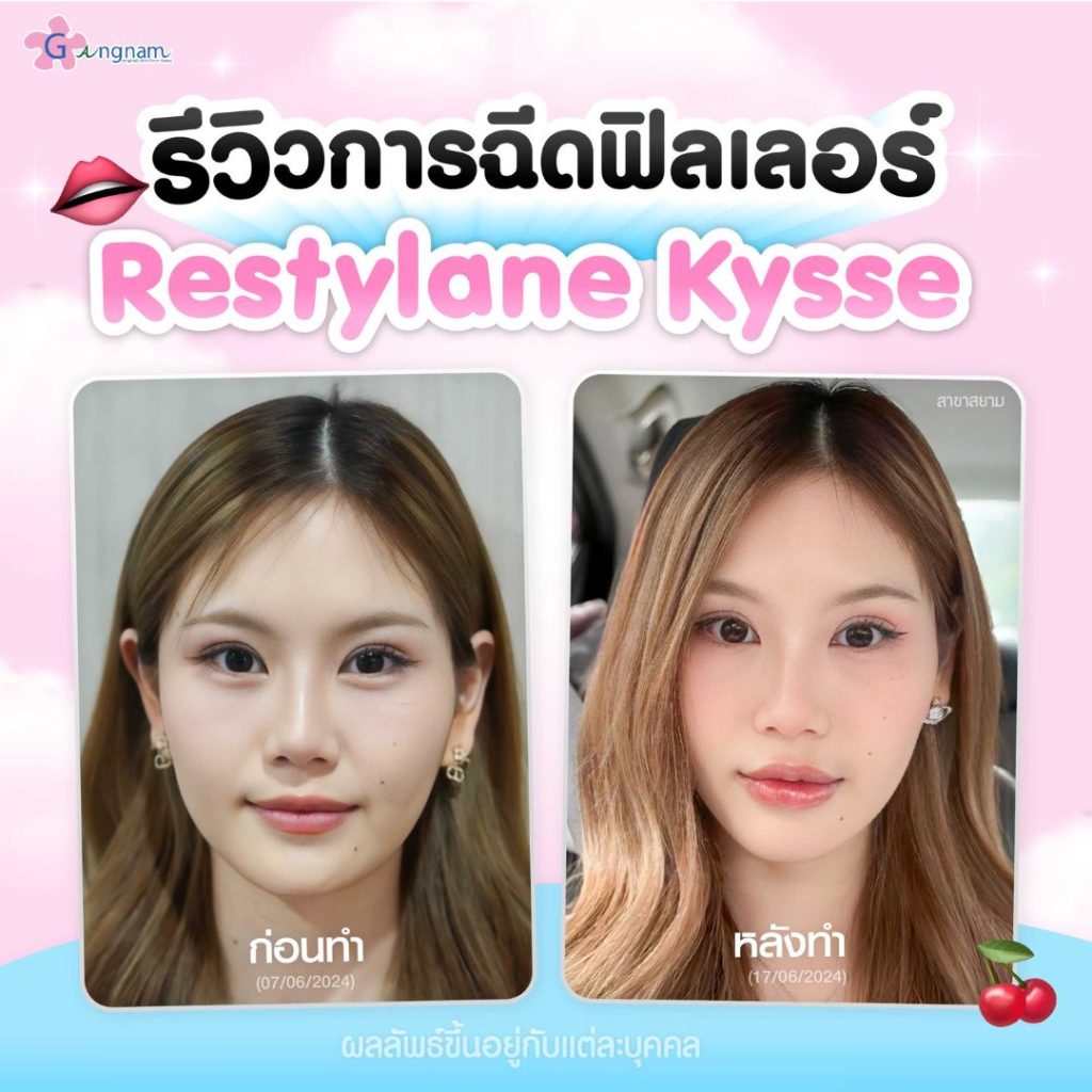 รีวิวการฉีดฟิลเลอร์ restylane kysse 1