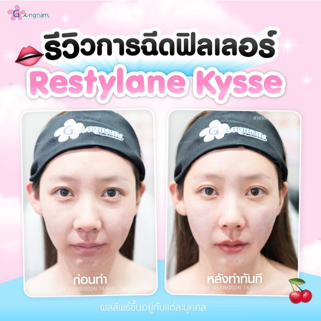 รีวิวการฉีดฟิลเลอร์ restylane kysse 2