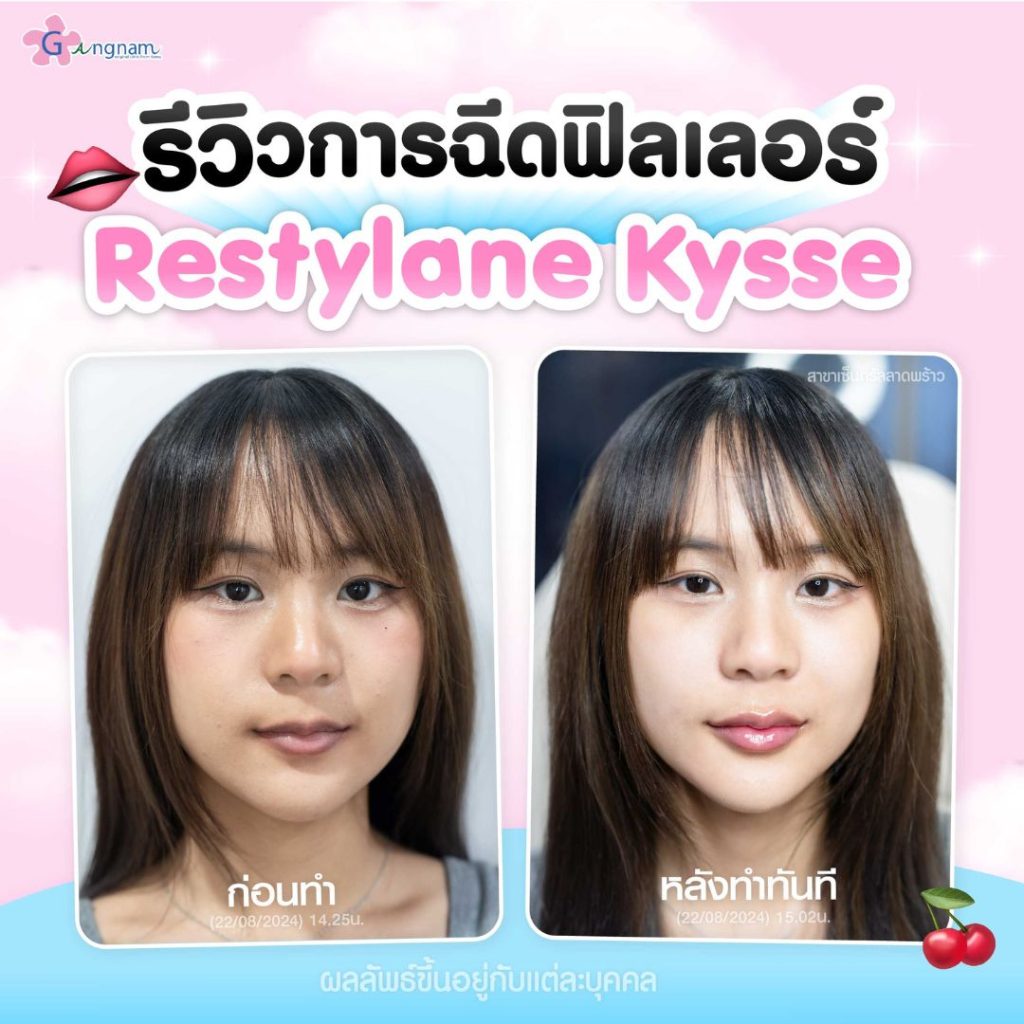 รีวิวการฉีดฟิลเลอร์ restylane kysse 3