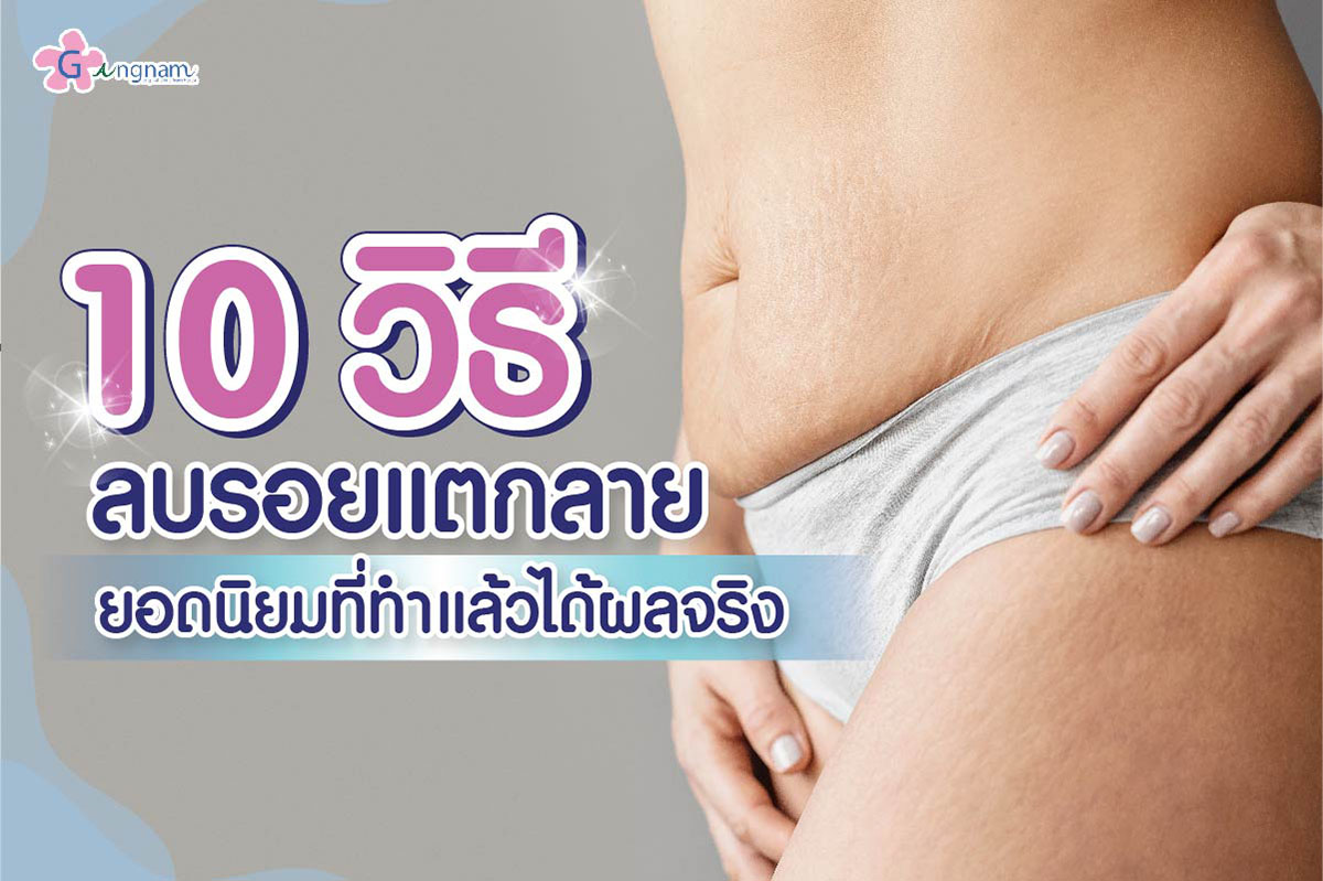 รอยแตกลาย เกิดจากอะไร? มีกี่แบบ ใช้วิธีรักษาต่างกันไหม?