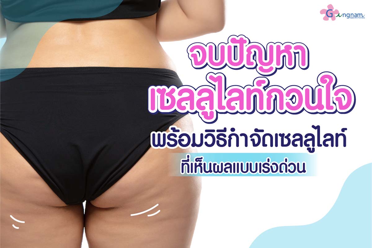 เซลลูไลท์ (Cellulite) คืออะไร? มีวิธีลดและกำจัดเซลลูไลท์อย่างไรให้เห็นผล -  Gangnam Clinic