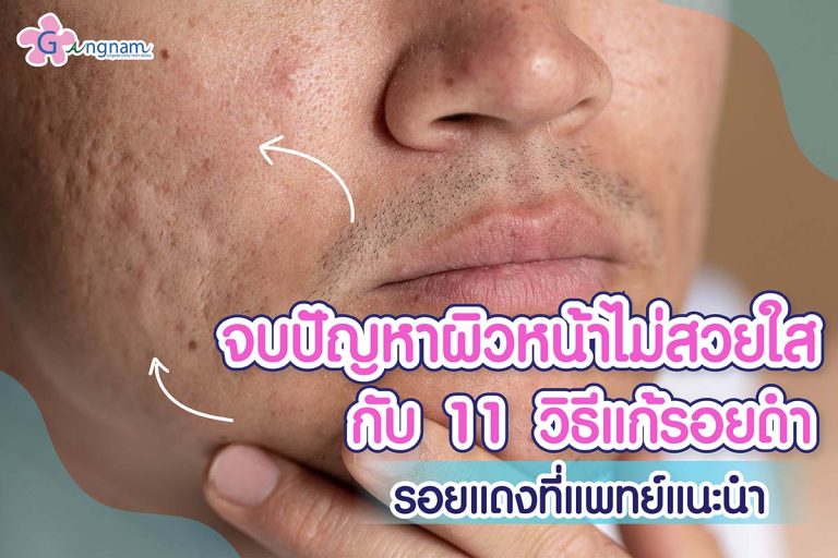 เป็นสิวที่หน้าผาก ไม่หายสักที เกิดจากอะไร? ควรรักษาด้วยวิธีไหนดี