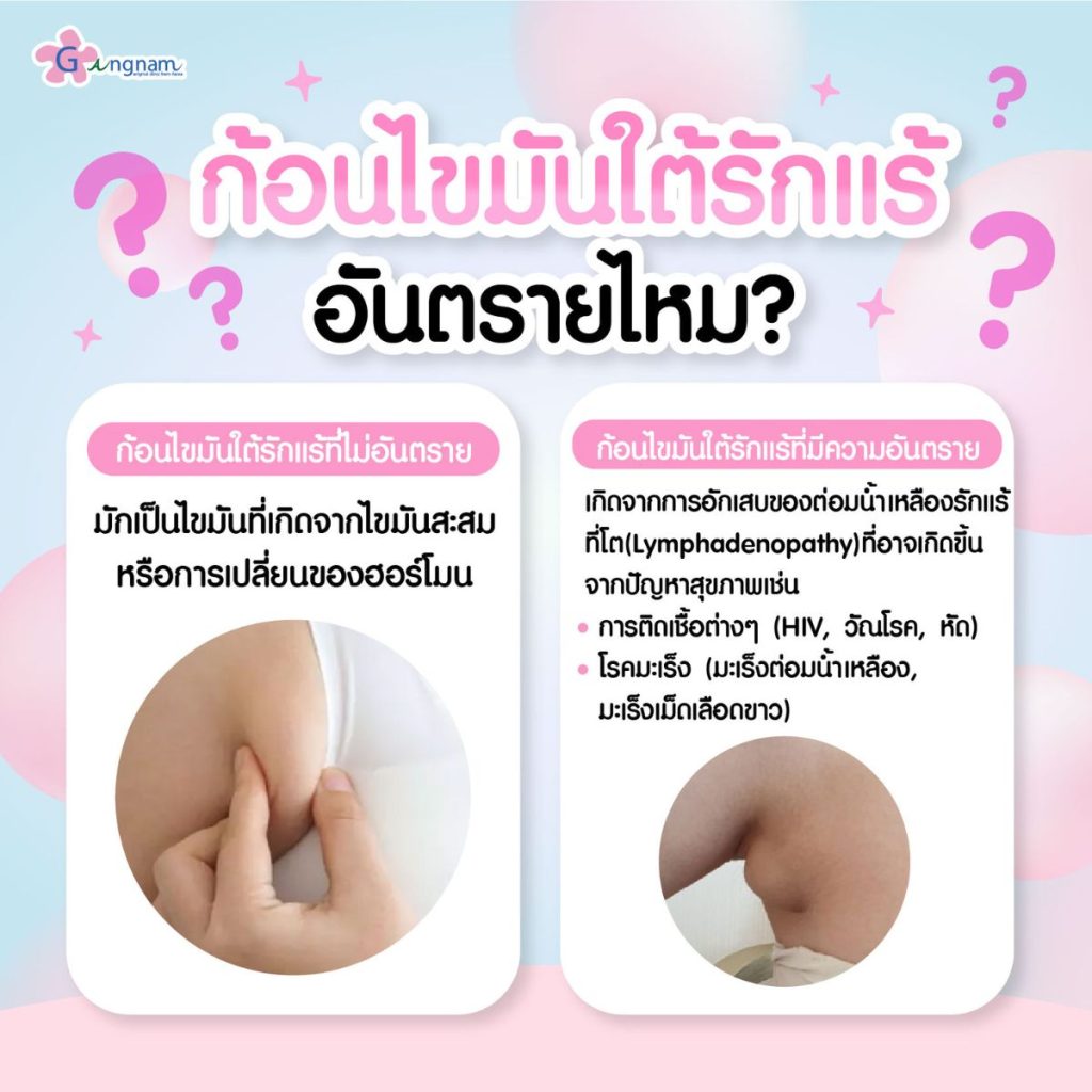 ก้อนไขมันใต้รักแร้อันตรายไหม