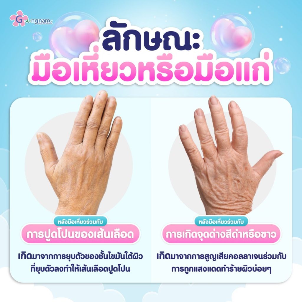 ลักษณะมือเหี่ยวหรือมือแก่