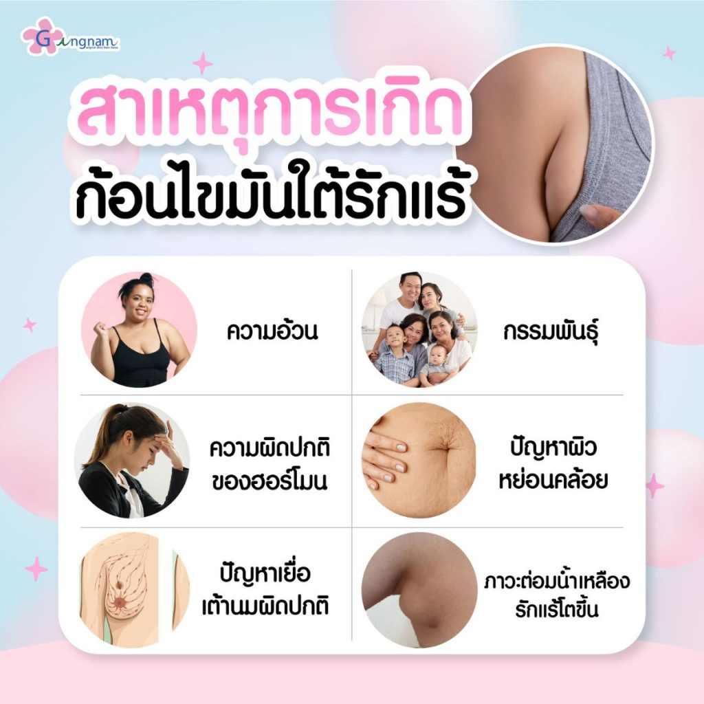 สาเหตุการเกิดก้อนไขมันใต้รักแร้