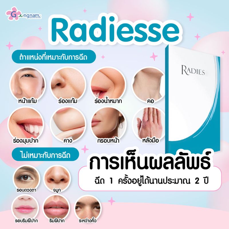 การเห็นผลของ Radiesse และตำแหน่งที่เหมาะกับการฉีด