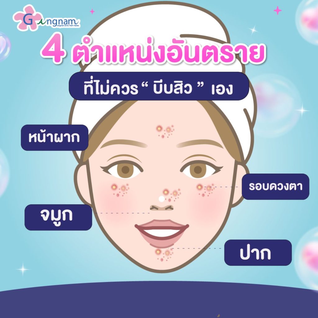 ตำแหน่งสิวที่ไม่ควรบีบเอง