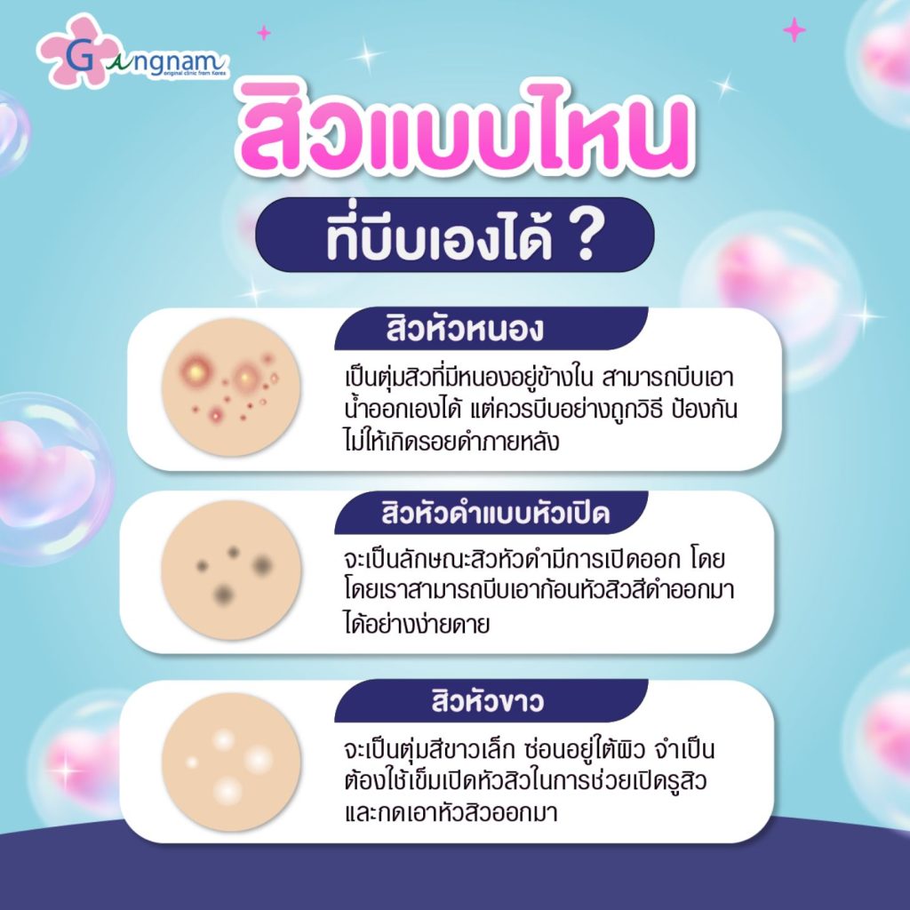 สิวแบบไหนที่บีบเองได้